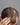 The Most Common Types of Hair Loss You’re Likely to See